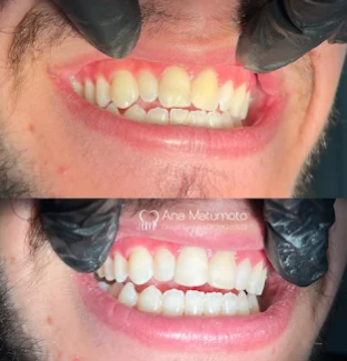 Antes e depois — facetas em resina composta